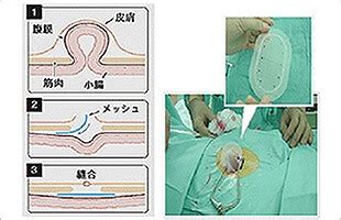 鼠径ヘルニアの日帰り手術（嵌頓、手術、費用）｜茨 